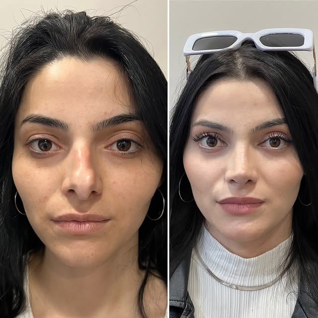نتيجة تجميل أنف حقيقية قبل وبعد - تارا ميديكال توريزم