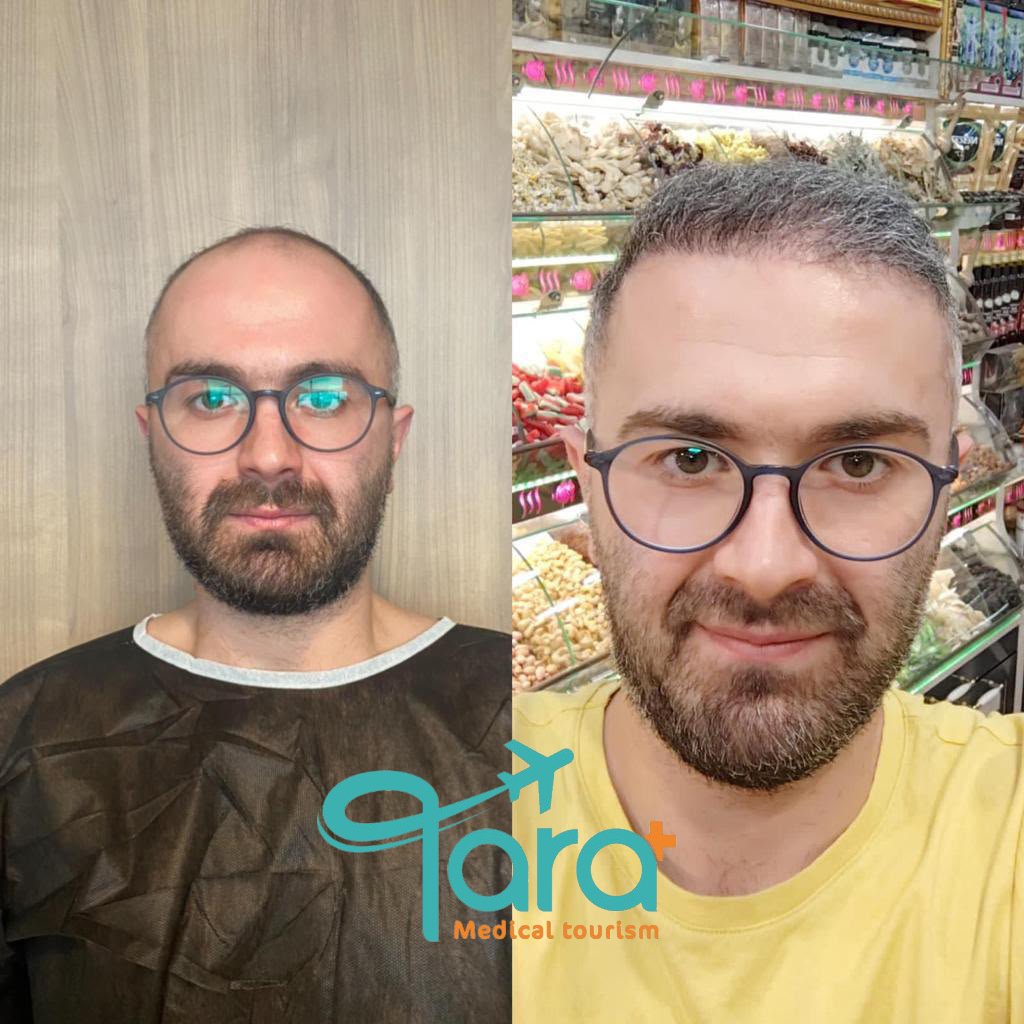 نتيجة زراعة شعر حقيقية قبل وبعد - تارا ميديكال توريزم