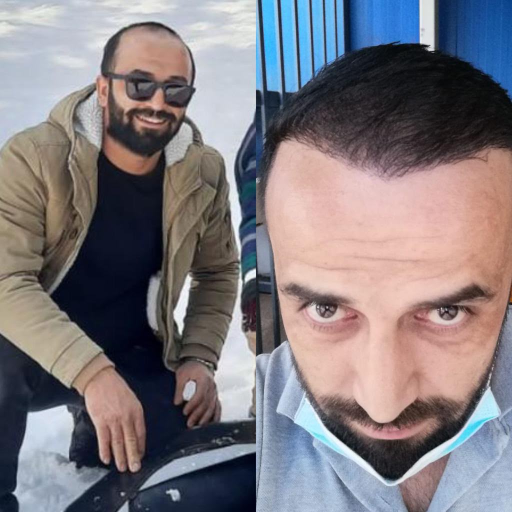 نتيجة زراعة شعر حقيقية قبل وبعد - تارا ميديكال توريزم